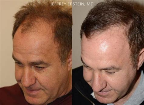 Hair Transplants For Men Pictures Miami Fl Paciente 40095
