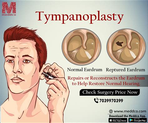 Tympanoplasty All You Need To Know About It