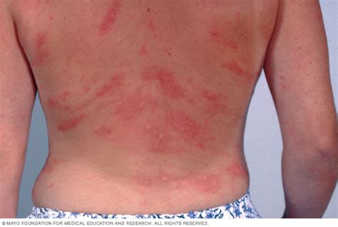 Hives And Angioedema Sparrow