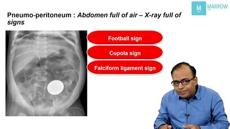 Conceptual Radiology On Marrow X Ray Signs In Pneumo Peritoneum Youtube