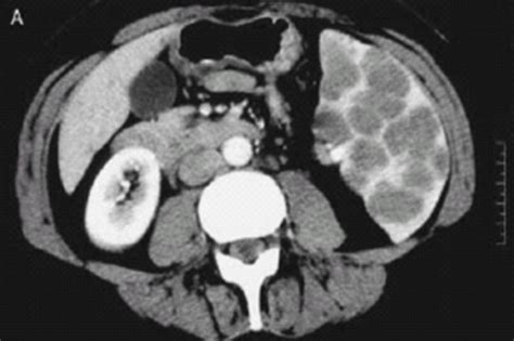 Ct Image Ct Scan Image Showing Multiple Splenic No Open I