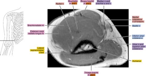 Mri Of The Arm Radiology Key