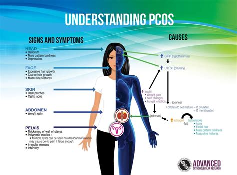 Image Result For Pcos Body Pcos Polycystic Ovarian Syndrome