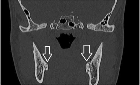 Bilateral Isolated Mylohyoid Groove Fracture Progressing As