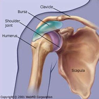 The purposes of this study were (1) to assess the construct validity of the shoulder pain and disability index (spadi) and (2) to determine whether the spadi is more responsive than the sickness impact profile (sip), a. Shoulder Bursitis Pain, Symptoms, Treatment & Pictures