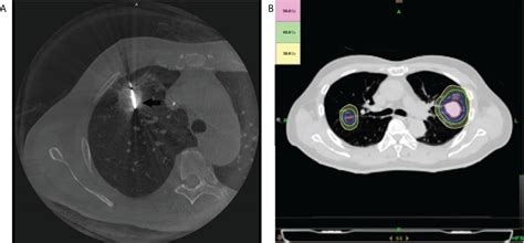 Frontiers Comparison Of Clinical Outcomes Between Cone Beam Ct Guided