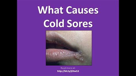 What Causes Cold Sores Fast Cure Youtube