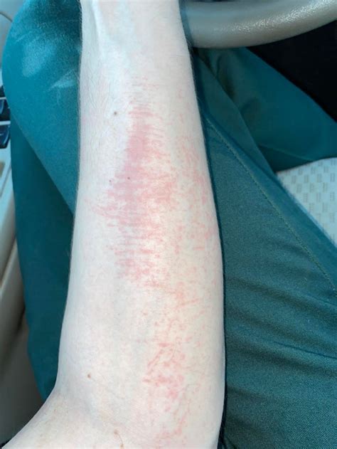 Day 2640mg Once Daily Itchy Rash On Both Arms Is This Something To