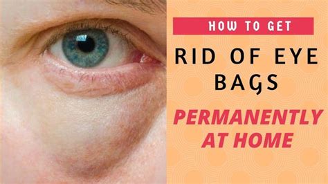 Best 3 Remedies For Puffy Eyeseye Bagsdark Circles How To Get Rid Of