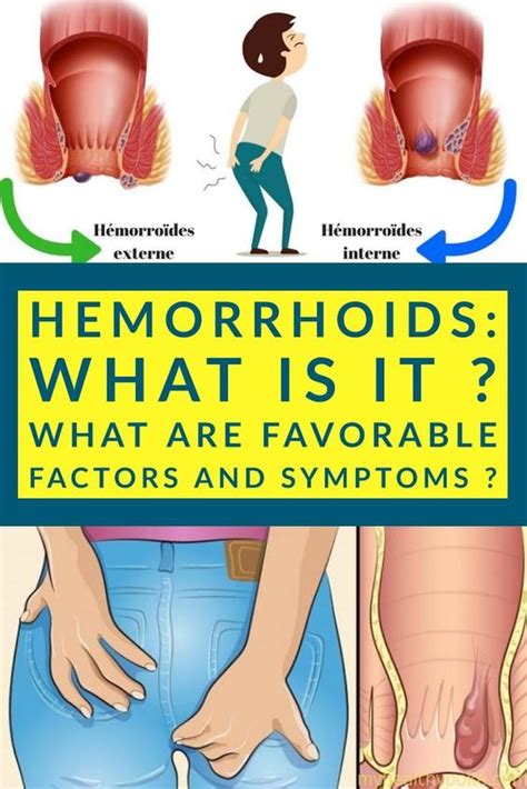 Hemorrhoids What Is It What Are Favorable Factors And Symptoms Page 11 Of 11 In 2020