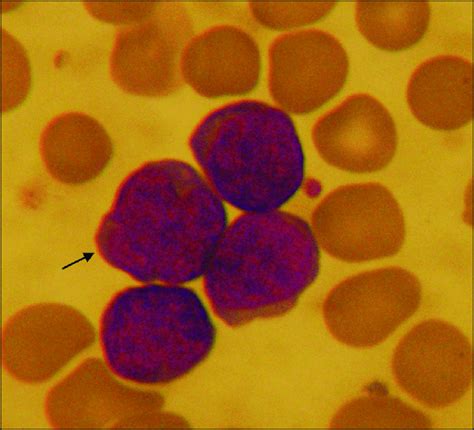 Flower Cell In Peripheral Blood Download Scientific Diagram