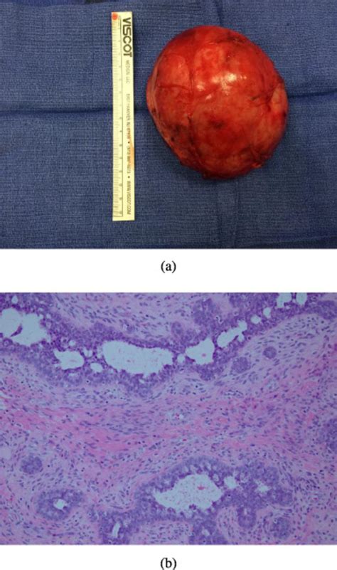 Giant Juvenile Fibroadenoma In A 9 Year Old A Case Presentation And
