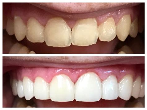 Dental veneers are thin covers that adhere to teeth to give teeth a more classically shaped look. Porcelain Veneers in West Caldwell: Cosmetic Dentistry