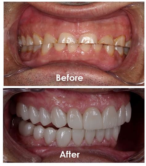 Full Mouth Reconstruction 16 Crucial Decisions For Your Dental Success