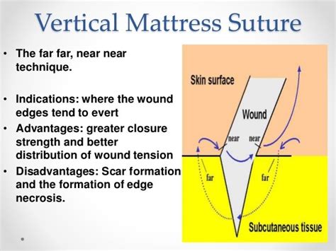 Mattress Vertical Mattress Suture