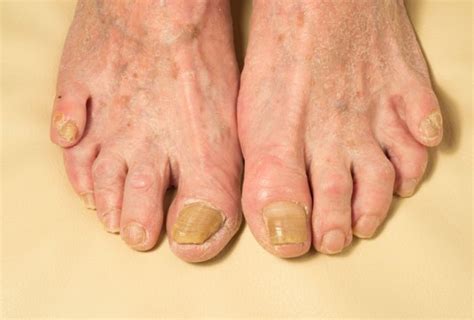 What Are The Causes And Treatment Of Foot Infections