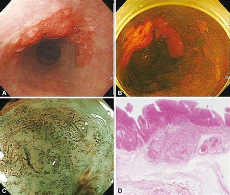 Esophageal Squamous Cell Carcinoma A A Depressed Lesion With