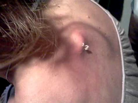This is the biggest zit ever, and it has to be popped! Biggest pimple ever | Epic Zit Pop