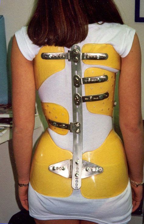 Pin By Billy Barue On Braces With Images Scoliosis Brace