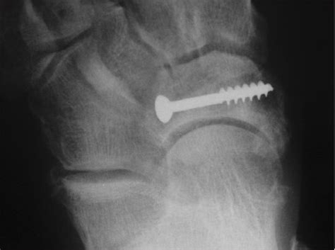 Navicular Stress Fracture In A Long Distance Runner Dr Nicks