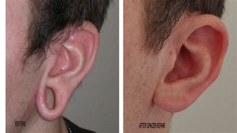 Ear Repair Surgery Lobe Guaging Calgary Ctv News