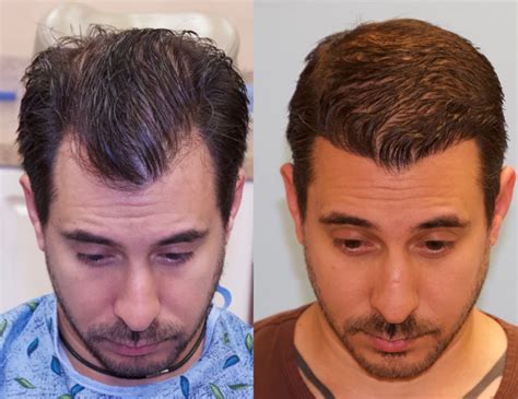 1500 Graft Hairline Restoration Carolina Hair Surgery