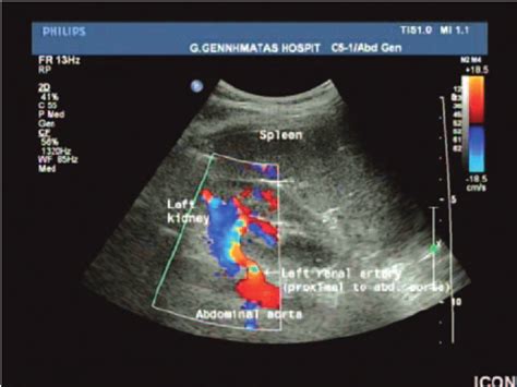 Kidney Doppler Ultrasound