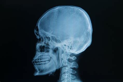 le crâne radiographie l image image stock image du squelette humain 42597699