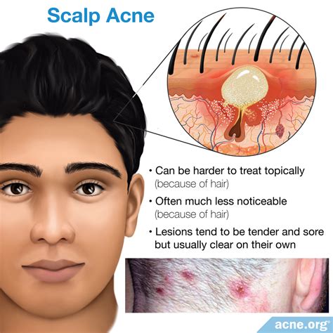 Scalp Pimples Causes And What Naturally Helps My Xxx Hot Girl