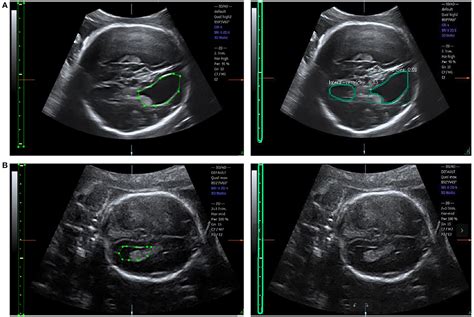 Frontiers Automatic Measurements Of Fetal Lateral Ventricles In 2d