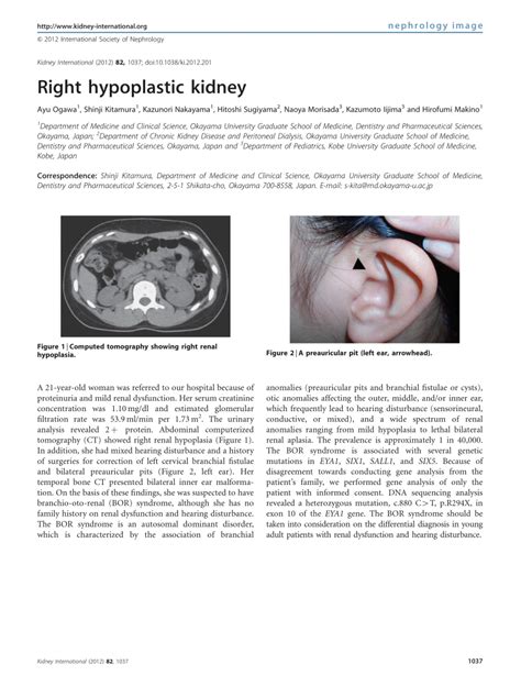Pdf Right Hypoplastic Kidney