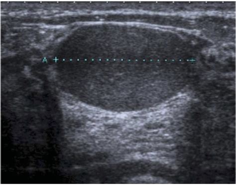 Variation In Management Of Breast Lesions With Ultrasound Appearances