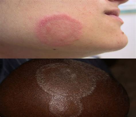 Ringworm Tinea Dermatophytosis Causes Symptoms Signs