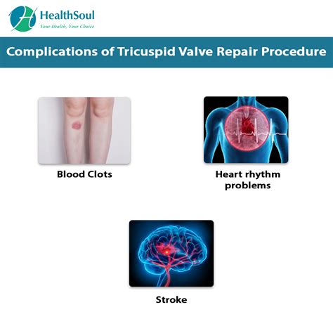 Tricuspid Valve Repair Healthsoul