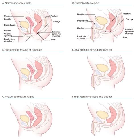 Anal Fistula In Infants Anal