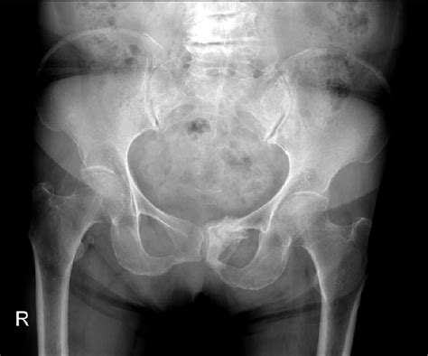 This Pelvis Anteroposterior Radiograph Shows Sclerotic Change And