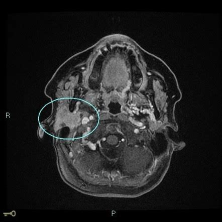 Parotid Adenocarcinoma Radiology Case Radiopaedia Org