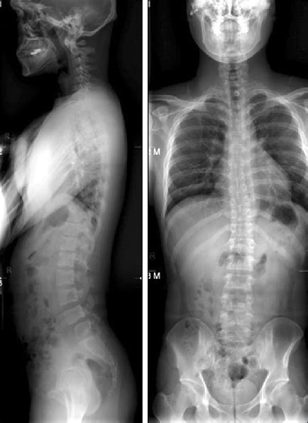 Whole Standing Spine X Rays Showing Normal Sagittal And Coronal Balance