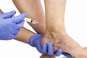 The Risks of Ignoring Your Varicose Veins - Physician's Vascular Services  Heart and Circulation Varicose Veins