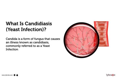 Candidiasis Yeast Infection Causes Symptoms Treatment And Cost