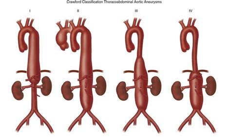 Thoracic Aortic Aneurysm Classification