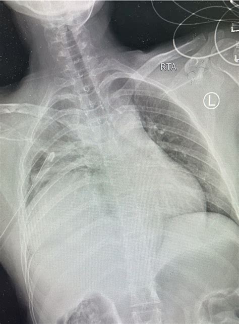 A Chest X Ray Indicates Opacities On The Right Side Of The Chest With
