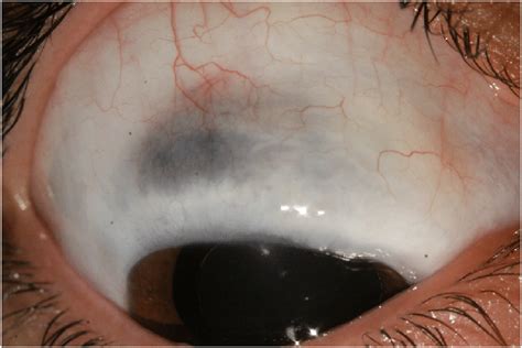 Multicystic Bleb And Severe Scleral Thinning In Right Eye Download