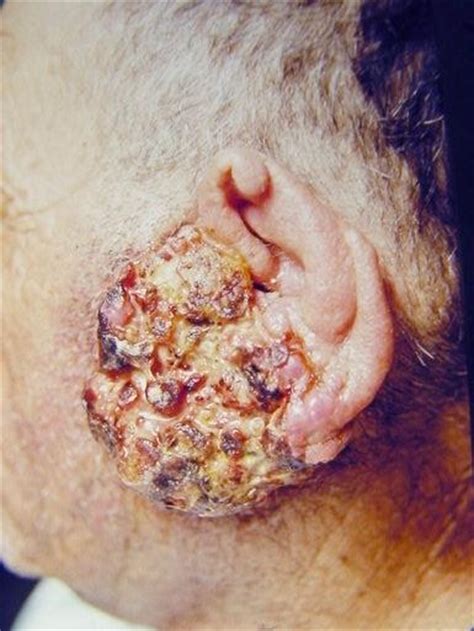 Otolaryngology Houston Pictures Of Squamous Cell