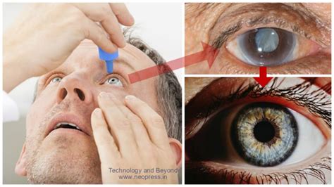 This Miracle Eye Drop Will Make You Say Goodbye To Cataracts
