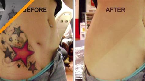 It sends out energy in one strong. Reset Tattoo Removal - YouTube