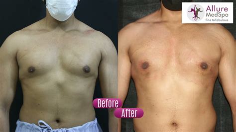 Puffy Nipple Gynecomastia Surgery Experience Under Local Anesthesia By Dr Milan Doshi Youtube