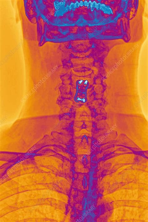 Treatment Of Neck Arthritis X Ray Stock Image C0017423 Science