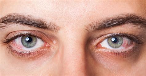 Dry Eyes Symptoms Causes Risk Factors And Complications