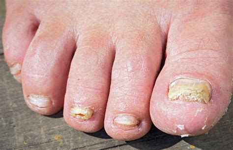 Can Toenail Fungus Cause Foot Pain Toenail Fungus Treatment Toenail Fungus Treatment